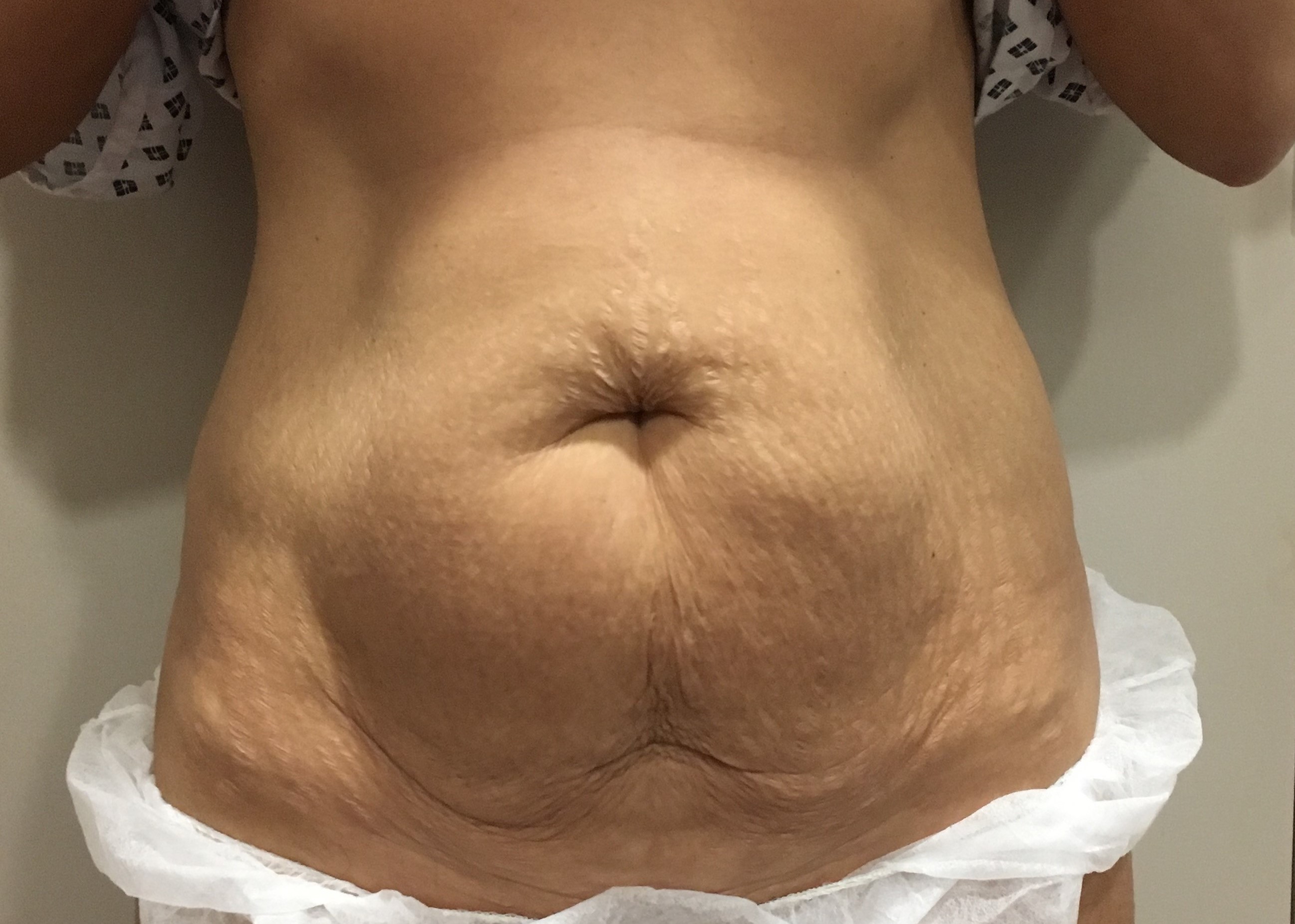 full tummy tuck recovery time